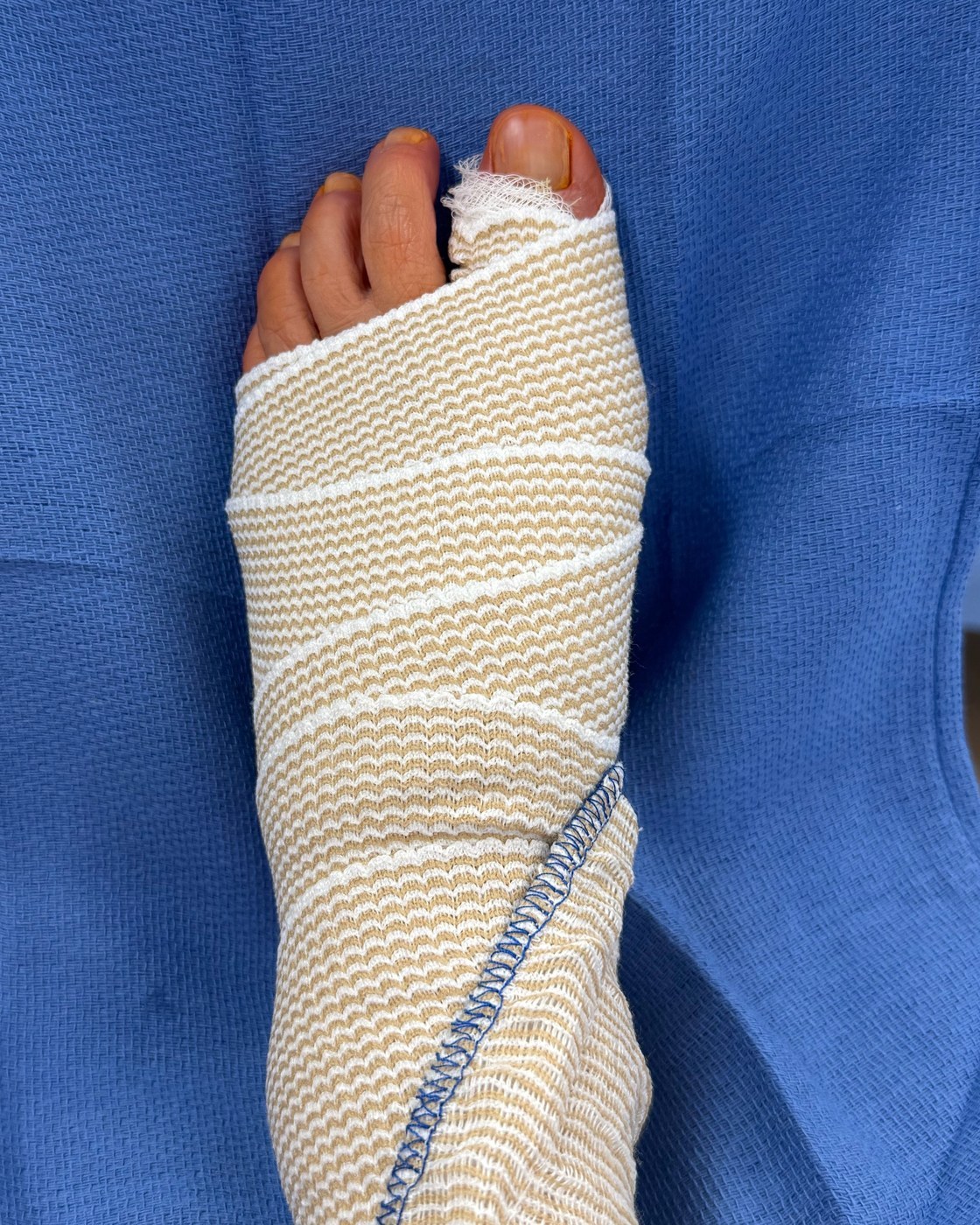 De-identified finished post-op compression dressing after The Jiffy Bunion™