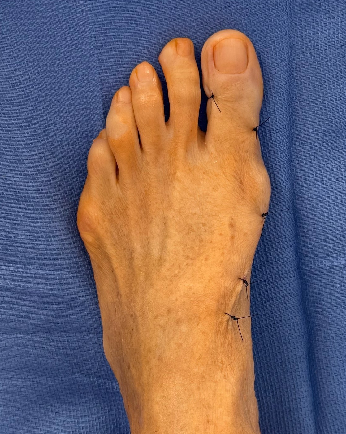 De-identified post-op foot showing tiny 1 mm incision sutures along medial border