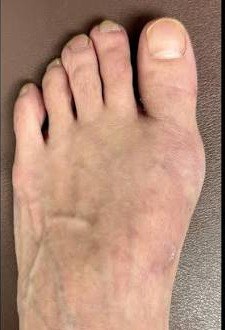 Same foot after healing from The Jiffy Bunion™ procedure