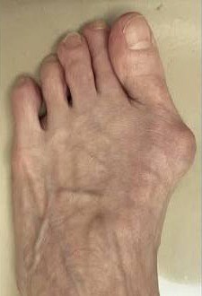 Foot with bunion deformity before surgery